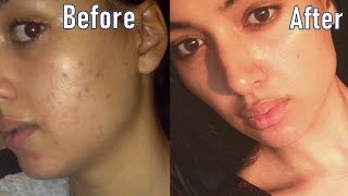 IS BENZOYL PEROXIDE GOOD FOR ACNE  HOW I CLEARED MY ACNE FAST   BEFORE AND AFTER RESULTS [upl. by Lura]