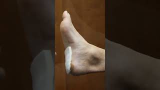 Retrocalcaneal Bursitis Treatment for Heel Bone Pain  Ankle amp Foot Centers of America shorts [upl. by Nesnej]