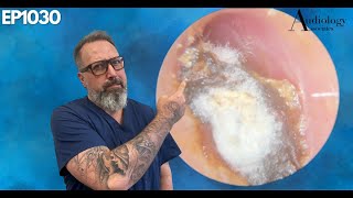 Deep Dry amp Difficult Furry Ear Wax Plug Removal  EP1030 [upl. by Nainatrad]