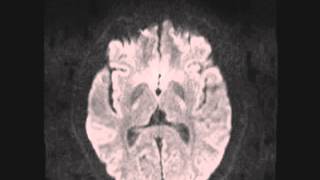 Germinoma Pineal amp Craniofacial Fibrous Dysplasia [upl. by Keven]