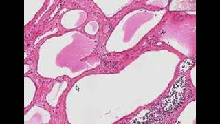 Histopathology NeckLymphangioma cystic hygroma [upl. by Shuler]