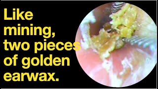 Like mining two pieces of golden earwaxear wax removal  ear cleaning  ASMR  relaxation  relax [upl. by Serafina]