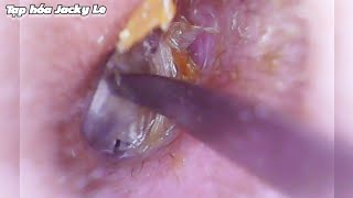 Ear Wax Removal 179 The ear canal is very narrow and small  Ear Cleaning ASMR [upl. by Bellamy]