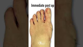 Minimally Invasive Bunion Surgery Before and After shorts [upl. by Enirtak]