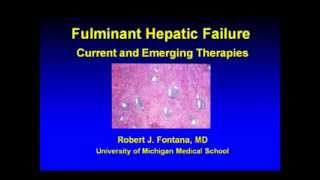 Fulminant Hepatic Failure Current and Emerging Therapies [upl. by Zetrauq]