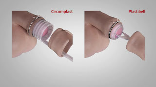 A comparison of Circumplast® and Plastibell® Circumcision Devices [upl. by Willet]