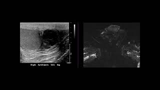 Epididymitis with abscess [upl. by Hatcher558]