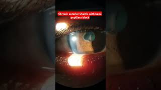 Chronic anterior Uveitis with hemi pupillary block neetpg ophthalmology shorts uveitis eyes [upl. by Ahsas]