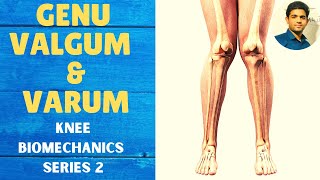 GENU VALGUM amp GENU VARUM  Knee Complex Biomechanics [upl. by Aener]