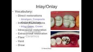 Introduction to inlaysonlays [upl. by Ursulina]