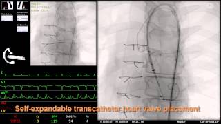 Mentice Aortic Valve Implantation TAVITAVR [upl. by Odella]