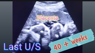 Baby BOY placenta position gender prediction  Anterior Placenta baby gender  how to reveal gender [upl. by Anitsirc]