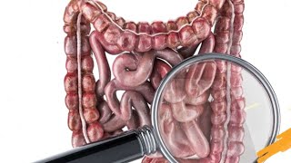 ¿Qué es el síndrome del intestino irritable SII [upl. by Verdie]