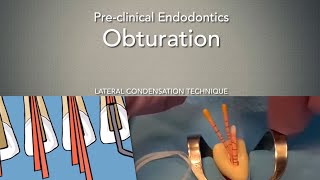 Obturation Lateral Condensation Technique [upl. by Ainoval177]