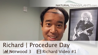 Hair Transplant Cost  Modern HUE Method McLean Virginia  Procedure Richard [upl. by Enyak]