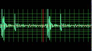 Normal Heart Sound normal speed [upl. by Martinic561]