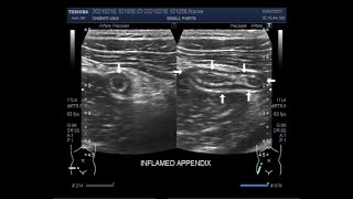 The scanning and localization of Acute Appendicitis [upl. by Isadore]