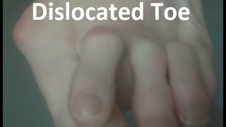 Dislocated Toe Pain Home Treatment Guide [upl. by Darla]