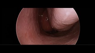 Angiofibroma Tumour of Nasopharynx [upl. by Anitan606]