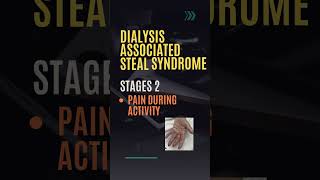 Steal Syndrome  Steal Syndrome in Dialysis  Dialysis Fistula Complication  Stages  Treatment [upl. by Anitsyrhc]