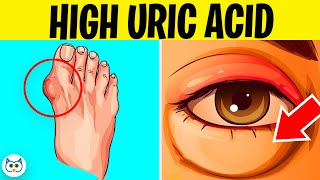 7 Symptoms of High Uric Acid Levels In The Body  Gout Symptoms [upl. by Eniloj817]