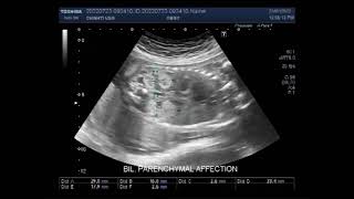 Fetal echogenic Kidneys with a distended urinary bladder [upl. by Secrest]