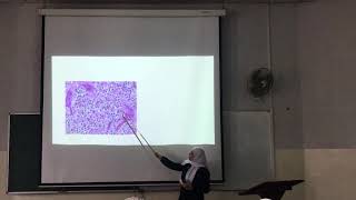 CNSpathologylecture9part2oligodendroglioma [upl. by Alliuqet]