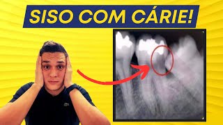 🚨DENTE do SISO com CÁRIE  Um Perigo OCULTO [upl. by Nguyen]