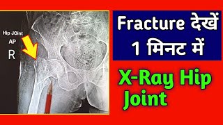 Fracture Proximal Femur Case 1  Intertrochanteric Fracture  XRay Hip Joint  UdayXray [upl. by Ilamad]