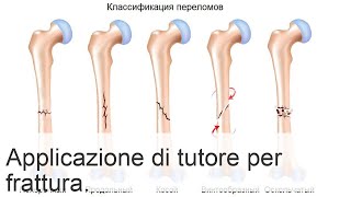 Immobilizzazione frattura femore articolazioni da fissare quando e perché [upl. by Leiruh]