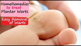 Treat Plantar Warts II How to Remove a Wart II How to Get Rid of a Plantar Wart Verrucas I Foot Wart [upl. by Ariayek]