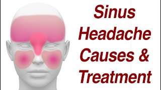 Sinus Headaches Causes amp Treatment [upl. by Arihday690]