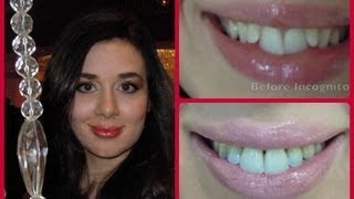 • Incognito Lingual Braces Treatment Halfway Update Before and After • [upl. by Nerual527]