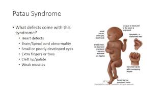 HSC 425  Down Patau Edwards Syndrome [upl. by Llenel18]