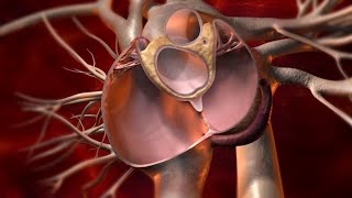 What is PFO  Closure of Patent Foramen Ovale to treat Cryptogenic Stroke [upl. by Guinevere]