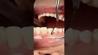 Retraction cord removal after composite veneer dentist dentalprocedure satisfying [upl. by Nnairb]