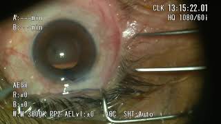 phacoemulsification in Small pupil USING MYDRANE from thea in the start [upl. by Goer]