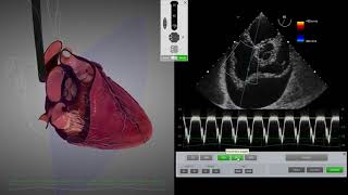 HeartWorks Cardiac Tamponade [upl. by Norehs]