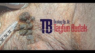 Kondilom  Genital Siğil  KoterizasyonuOP DR TAYFUN BUDAK [upl. by Wey846]