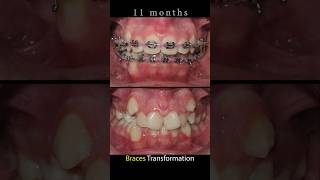 Braces crooked teeth braces orthodontist beforeandafter dentist orthodontictreatment [upl. by Innig]