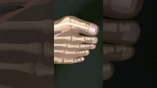 Minimal Invasive Bunion SurgeryVideo credit The Bunion Surgery Youtube [upl. by Hedges]