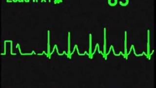 ECG Simulator  Sinus Arrhythmia  HRV [upl. by Cul]