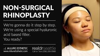 NonSurgical Rhinoplasty Best Technique to Build a Bridge for Asian Noses by Dr Seattle [upl. by Matthews]