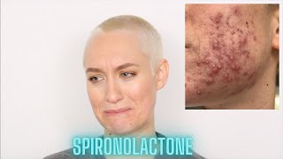 My Spironolactone amp Differin Experience  How I Cleared My Acne In 3 Months  Kiki G [upl. by Julis]