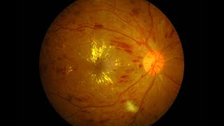 A Case Report on Subretinal Choroidal Neovascular Membrane [upl. by Jeanelle29]