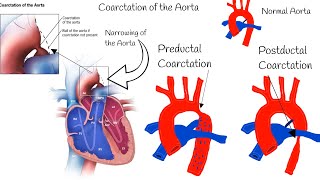 Coarctation of the Aorta  Symptoms Diagnosis and Treatment [upl. by Agata273]