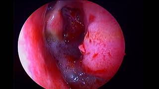 Left inverted papilloma with sinonasal polyposis [upl. by Amora]