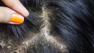 dandruff removal huge flakes scratching on head13 [upl. by Atinhoj]