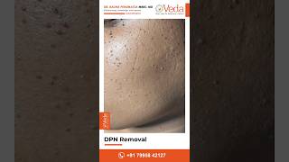 DPN removal Treatment  Black spots warts removal on face  veda skin and hair clinic Kompally [upl. by Ettennahs950]