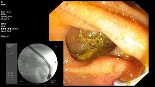 ERCP  Peridiverticular type ampulla EST with balloon swept [upl. by Rellek]